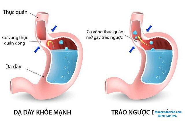 Nguy hiểm đến từ trào ngược dạ dày thực quản