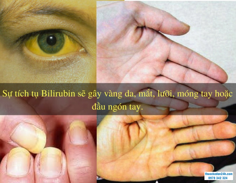 Sỏi đường mật trong gan - Những điều bạn cần biết