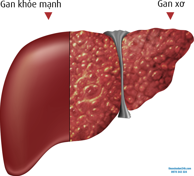 Sỏi đường mật trong gan - Những điều bạn cần biết