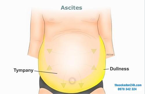 Biểu hiện xơ gan cổ trướng như thế nào?