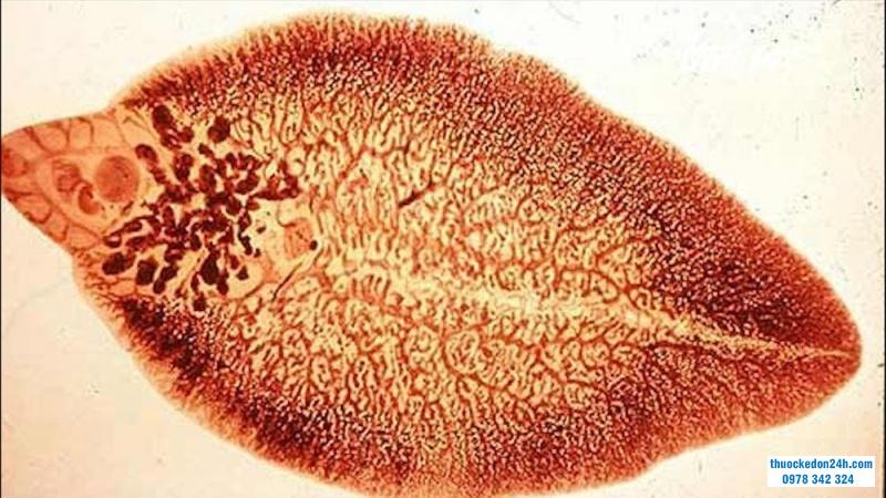 BỆNH SÁN LÁ GAN: NGUYÊN NHÂN, TRIỆU CHỨNG, CÁCH PHÒNG NGỪA