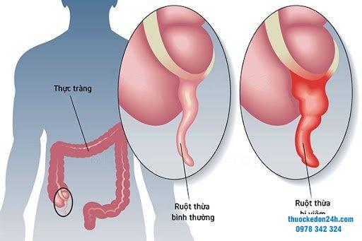 Nhận biết ruột thừa đau bên nào và cách điều trị hiệu quả
