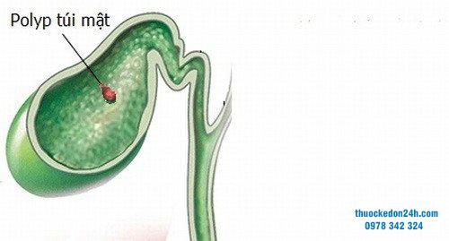 Polyp túi mật