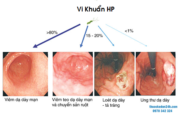 Các bệnh sau khi nhiễm vi khuẩn HP