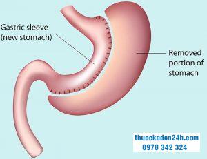 Những điều cần biết về phẫu thuật cắt dạ dày?