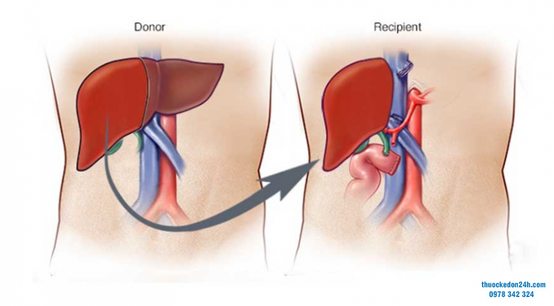 Phẫu thuật cấy ghép gan