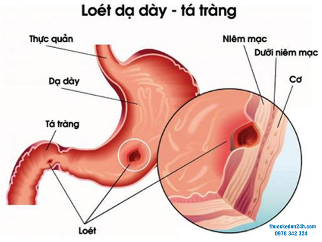 Điều trị loét dạ dày tá tràng