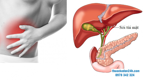 Nhận diện cơn đau bụng do sỏi mật gây nên