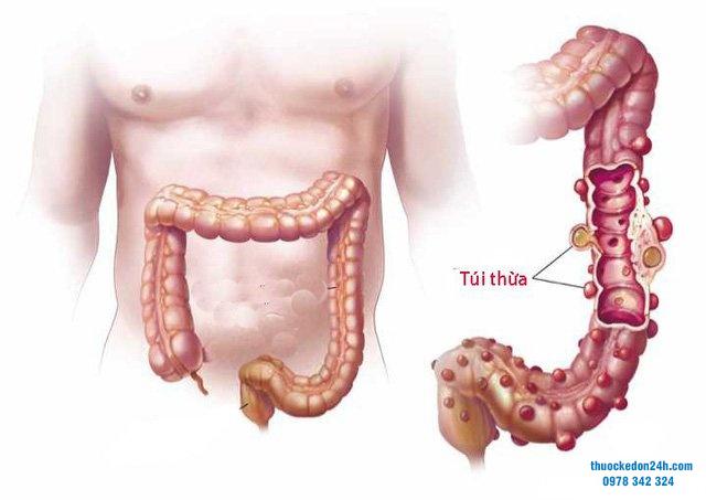 Viêm túi thừa đại tràng