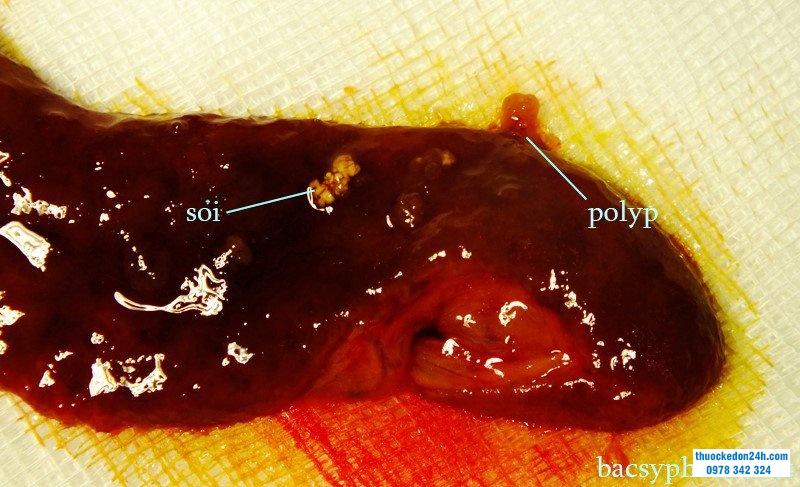 Sỏi và polyp túi mật