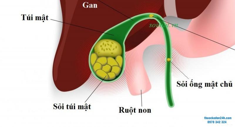 Phòng ngừa sỏi ống mật chủ tái phát sau mổ