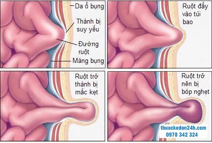 Thoát vị bẹn nghẹt