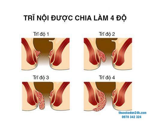 Trĩ nội độ 2 có