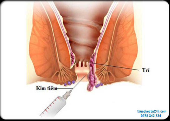 Trĩ nội độ 2 có cần phẫu thuật