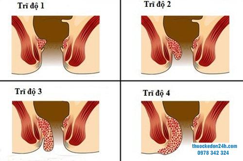 Trĩ nội độ 3 có cần phẫu thuật