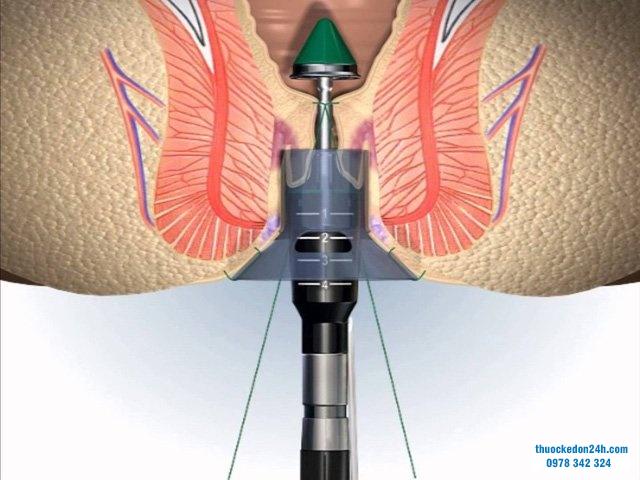 Trĩ nôi độ 3 có cần phẫu thuật