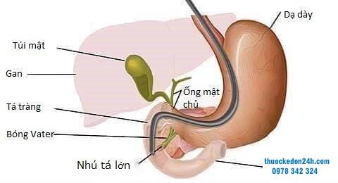 Nội soi mật tụy ngược dòng