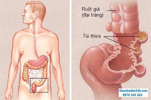 Viêm túi thừa đại tràng