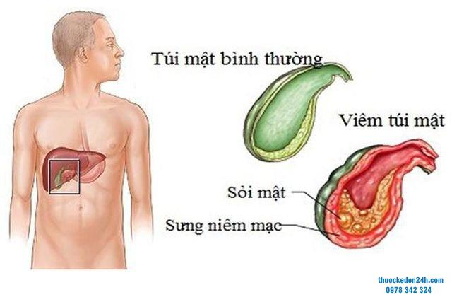 Viêm túi mật cấp