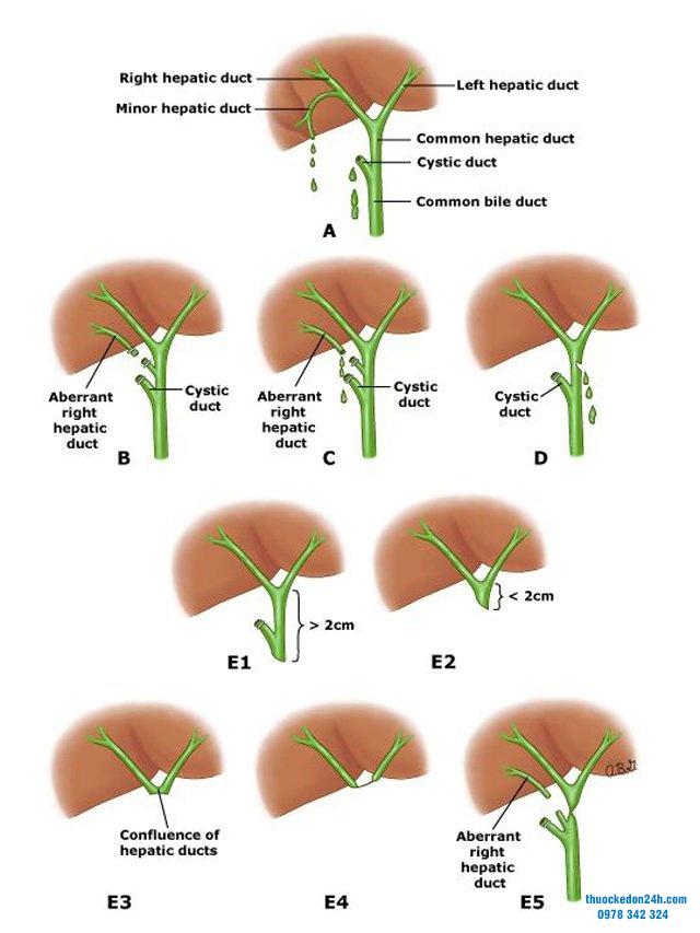 Hình ảnh đường mật bị tổn thương trong trường hợp khác nhau