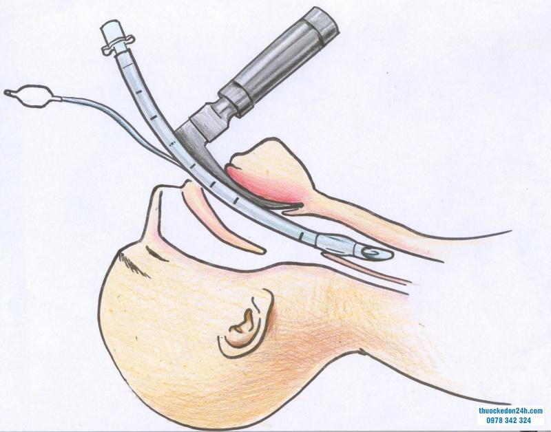 Đặt nội khí quản qua đường miệng