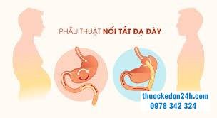 phẫu thuật nối tắt dạ dày