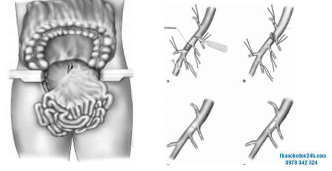 vai-tro-cua-phau-thuat-trong-chan-doan-va-dieu-tri-tac-mach-mac-treo-2