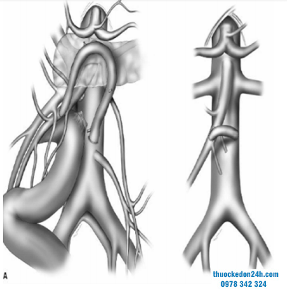 vai-tro-cua-phau-thuat-trong-chan-doan-va-dieu-tri-tac-mach-mac-treo-3