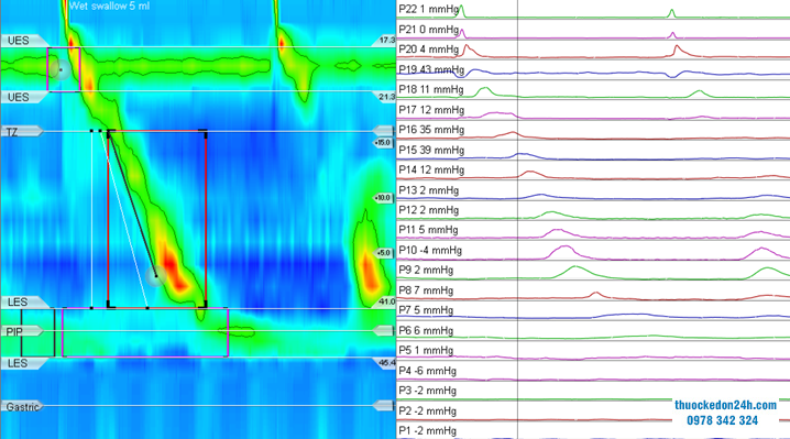 Đo vận động thực quản 24 giờ