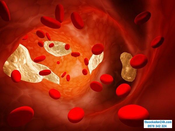 Tăng triglyceride máu có thể gây viêm tụy cấp nặng