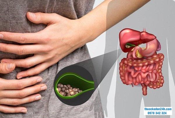 Sỏi mật là nguyên nhân do cơ học gây viêm tuỵ cấp nặng