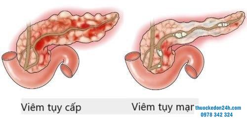 Viêm tuỵ cấp