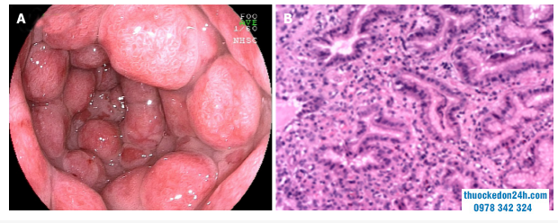 Biểu hiện nội soi và vi thể của viêm loét đại tràng liên quan đến viêm dạ dày