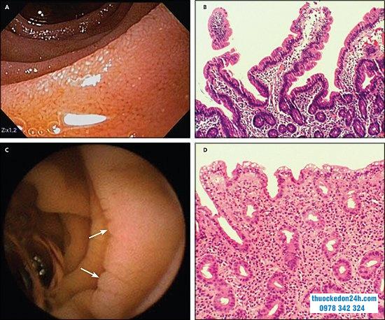 Viêm tá tràng có sự trùng lặp với bệnh celiac