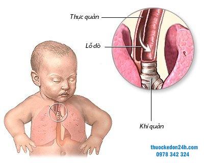 Lỗ dò thực quản