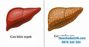 gan nhiễm mỡ