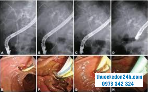 Phòng ngừa viêm tụy cấp sau nội soi mật tụy ngược dòng