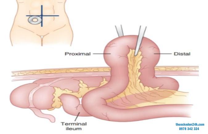 phẫu thuật chữa viêm loét đại tràng