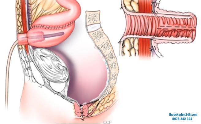 phẫu thuật chữa viêm loét đại tràng