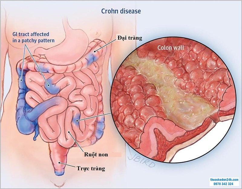 bệnh crohn