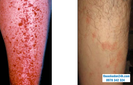 cơ chế bệnh sinh của helicobacter pylori