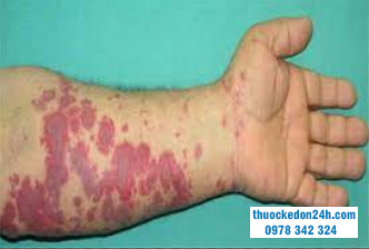 cơ chế bệnh sinh của helicobacter pylori
