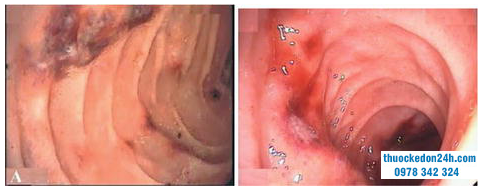 Nội soi thấy phần thứ hai của tá tràng.