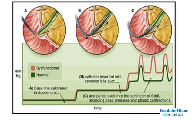 Rối loạn chức năng cơ vòng Oddi