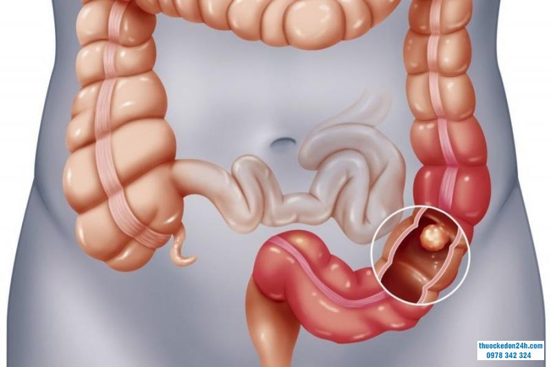 nội soi đại tràng định kỳ