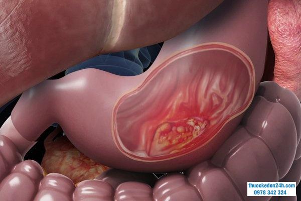 Dạ dày cơ thể chúng ta và những điều cần biết